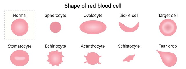 Red blood cell morphology. Shape of red blood cell. Spherocyte, Ovalocyte, Sickle cell, Target cell, Stomatocyte, Echinocyte, Acanthocyte, Schistocyte and Tear drop.