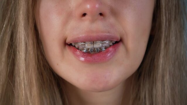Woman smile with ceramic and metal braces. Dental teeth health care.