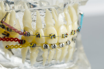 Mould of human teeth close up. dental gypsum model. Plaster cast human jaws prosthetic laboratory. Dentistry teeth care imag