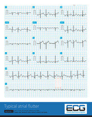 Male, 58 years old, clinically diagnosed as COPD. Paroxysmal atrial flutter and atrial fibrillation were found by ambulatory electrocardiogram.