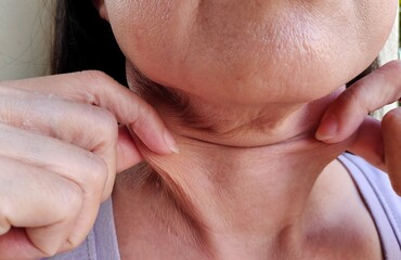Portrait showing the fingers squeezing flabbiness adipose hanging under the neck, problem wrinkles and flabby skin under the chin, concept health.
