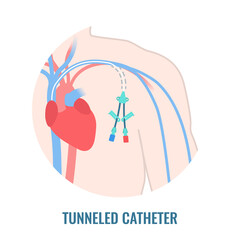 Tunneled central venous catheter placed in the subclavian vein. Man with CVC long term access device for chemotherapy infusions and blood sampling. Central line tube close up. Vector illustration. - obrazy, fototapety, plakaty