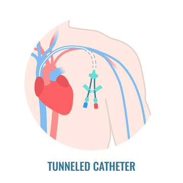 Tunneled central venous catheter placed in the subclavian vein. Man with CVC long term access device for chemotherapy infusions and blood sampling. Central line tube close up. Vector illustration.