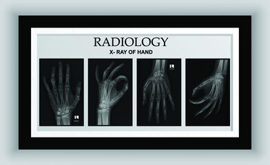 X-RAY OF HAND