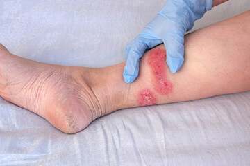 doctor treats large healing wound from on lower leg with scars of adult female patient, redness,...