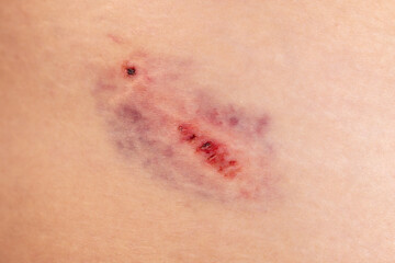 Fototapeta premium Closeup Bruise on wounded woman leg skin. Domestic violence. Large bruise on the thigh of a woman. Gender violence concept
