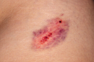Closeup Bruise on wounded woman leg skin. Domestic violence. Large bruise on the thigh of a woman....