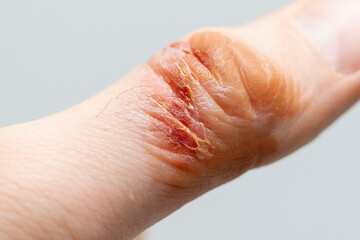 Chemical burn of a thumb finger. Household burn. An open deep wound. Damaged epidermis. Regeneration process. Macro view.