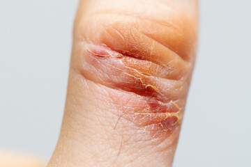Chemical burn of a finger. Household burn. An open deep wound. Damaged epidermis. Regeneration process. Macro view.