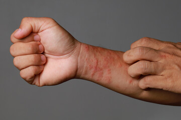 Close up allergic rash dermatitis eczema skin of patient wrist. - obrazy, fototapety, plakaty