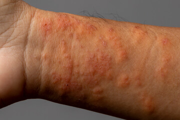 Close up allergic rash dermatitis eczema skin of patient wrist.