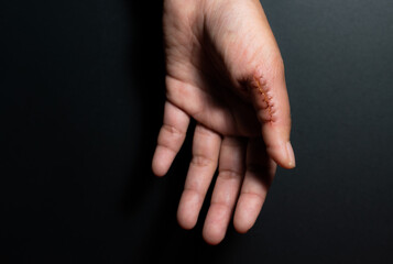 Close-up of a hand wound with stitches, thumb wound on black background. scar, suture, accident