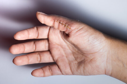 Close-up of a hand wound with stitches, thumb wound on white background. scar, suture, accident