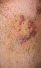 Large hematoma on the leg after a medical operation.