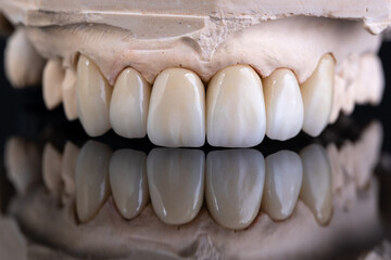 Fototapeta na wymiar Dental health care. Ceramic zirconium in final version. Close up dental zircon ceramic crowns on black background
