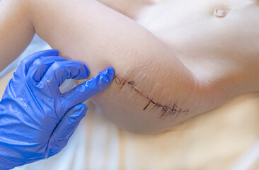 close-up of human skin with strips for sutures and wound closure or surgical tape after surgery on...