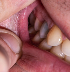 A dark tooth in a man's mouth after injury. Tooth decay by caries, dentistry. Macro