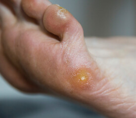 Plantar wart and callus on the patient's foot. Removal of warts and skin care on the soles of the feet, macro