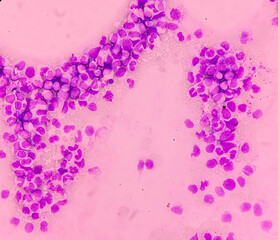 Chronic myeloid leukemia cells or CML, Microscopic examination show the increased and unregulated growth of myeloid cells in blood.