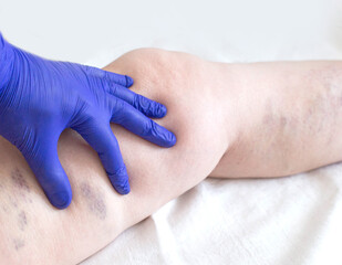 The doctor examines the leg of a patient who has varicose veins and venous thrombosis. Varicose veins treatment, close-up - obrazy, fototapety, plakaty