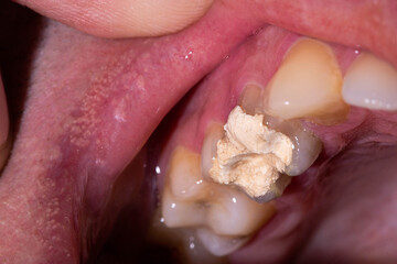 Tooth filling with temporary cement for root canal treatment. Tooth nerve removal, preparation for...