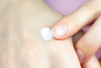 Woman applying hands cream. Irritated, problem skin of hands. Dermatology concept. Close up.