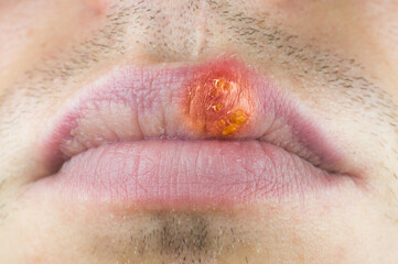 Fototapeta premium Herpes labialis on the lip of a Caucasian man. Face close-up..Сold sores illness disease. Simplex virus.