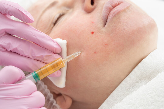 Cosmetologist makes prp-therapy blood plasma against wrinkles around the eyes and skin aging on the face of an adult woman Real procedure. The concept of cosmetology.