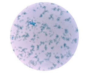 Close view of Reticulocyte count under microscope, methylene blue staining