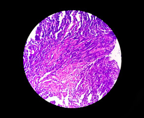 Tissue from terminal ileum: Chronic nonspecific ileitis or inflammation of the ileum, is often caused by Crohn's disease. inflammatory bowel disease (IBD).