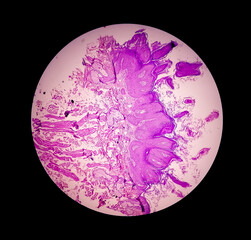 High magnification of skin cells infected with the HPV Virus. Common Wart. Verruca vulgaris. Microscopic view.