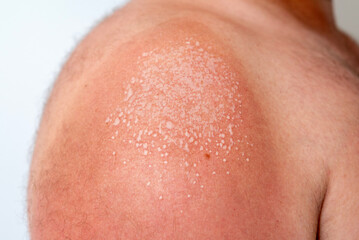Fototapeta premium fresh sunburn bubbles on a man's shoulder. use uv protection