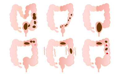 Vector illustration set of constipation types. - obrazy, fototapety, plakaty