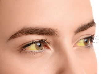 Young woman with yellow eyes on white background, closeup. Hepatitis symptom