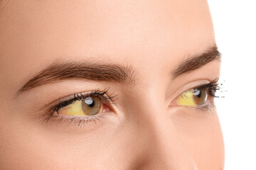 Obraz premium Young woman with yellow eyes on white background, closeup. Hepatitis symptom