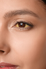Obraz premium Young woman with yellow eyes, closeup. Hepatitis symptom