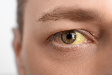 Man with yellow eyes, closeup. Hepatitis symptom - obrazy, fototapety, plakaty