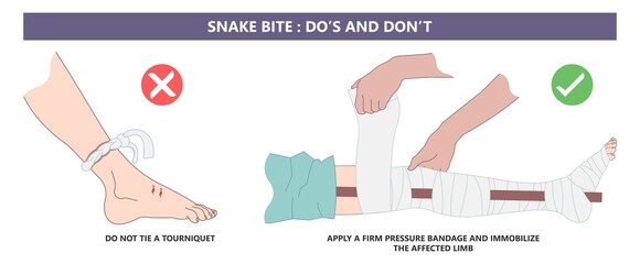 Snake Bite First Aid care non venomous anti venom serum hand leg king cobra treat kit death injury help safe call pain blood healing prevent coral fangs step poster grabbing splint limb sign tongs