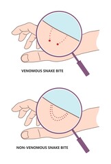 Snake Bite First Aid care non venomous anti venom serum hand leg king cobra treat kit death injury help safe call pain blood healing prevent coral fangs step poster grabbing splint limb sign tongs