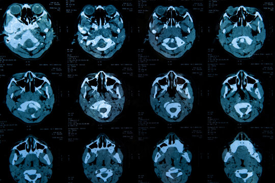 Closeup view of a MRI head scan with brain