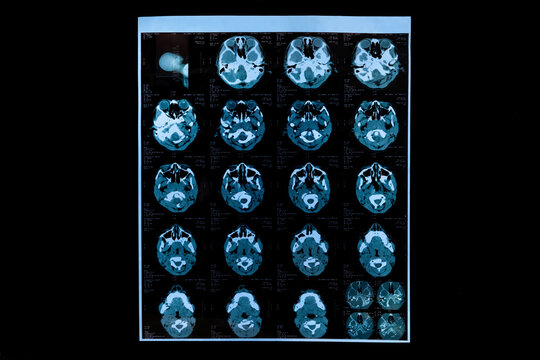 a MRI head scan with brain image on black background
