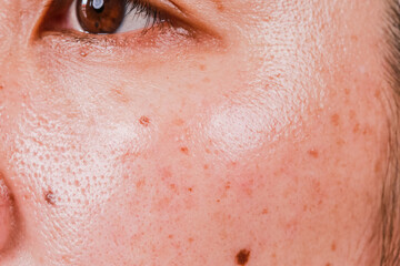 Fototapeta premium Skin care problems and health concepts spots blemish dry