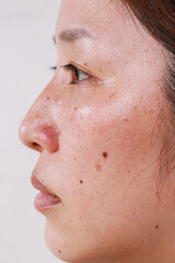 woman's face, half face portrait with blemish large pores black dots