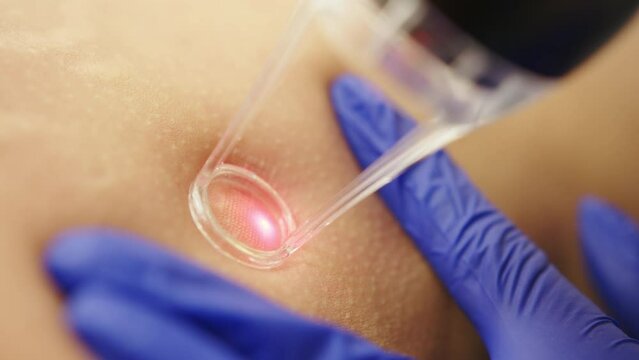 Laser cosmetic surgery and skin resurfacing in dermatology. Beauty laser technician performing skin resurfacing procedure in a medical spa and beauty clinic. Laser pulses cleanse the skin
