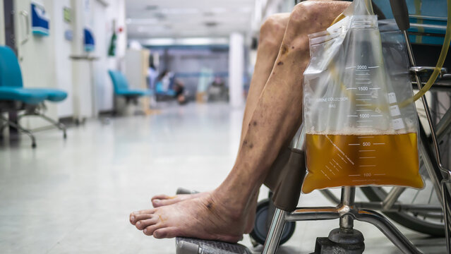 Asian elderly man patient sitting on wheelchair with urine bag in the hospital ward, healthy medical concept