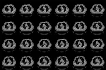 Overview of a computed tomography scan of a patient with a lung tumor