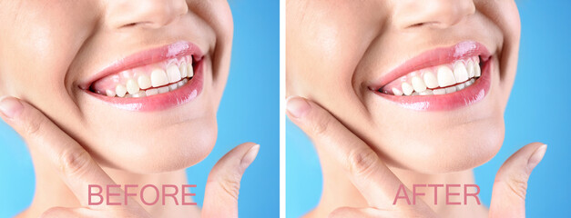 Young woman before and after gingivoplasty procedure on light blue background, closeup. Banner design