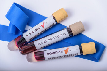 Suspected adenovirus as a culprit in childhood hepatitis of unknown origin. Hepatic, sars-cov2.