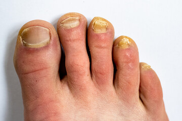 Adult man foot with the nail fungal infection.