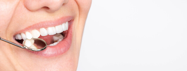 Banner perfect white teeth veneer smile with dental mirror close up, female winner smile, dental...